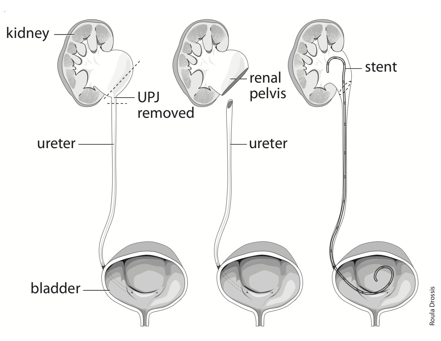 Laparoscopic Pyeloplasty | Mr Isaac Thyer